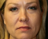 Feel Beautiful - Filler Lower Eyelids and Corners of Lips - After Photo